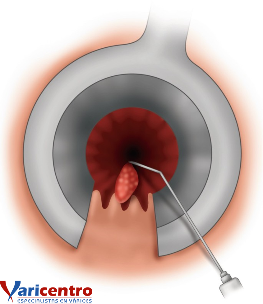 Escleroterapia con espuma en Hemorroides